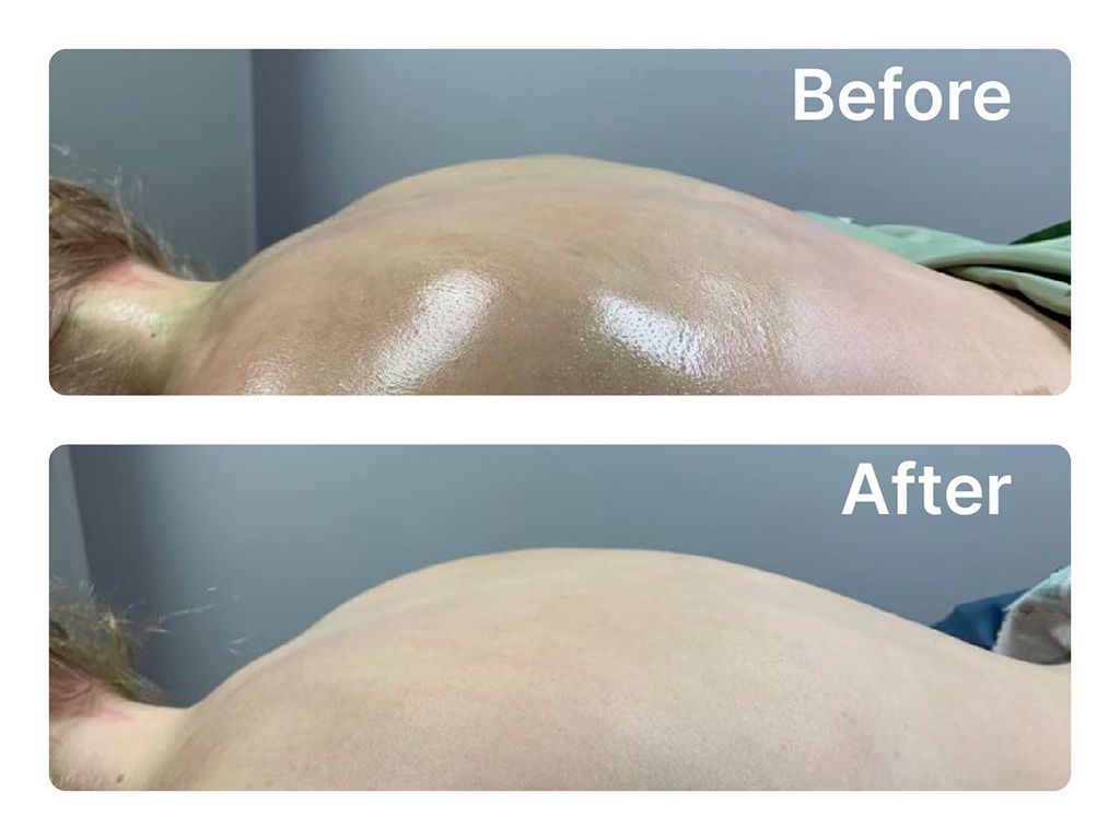 A before and after picture of a woman 's back.
