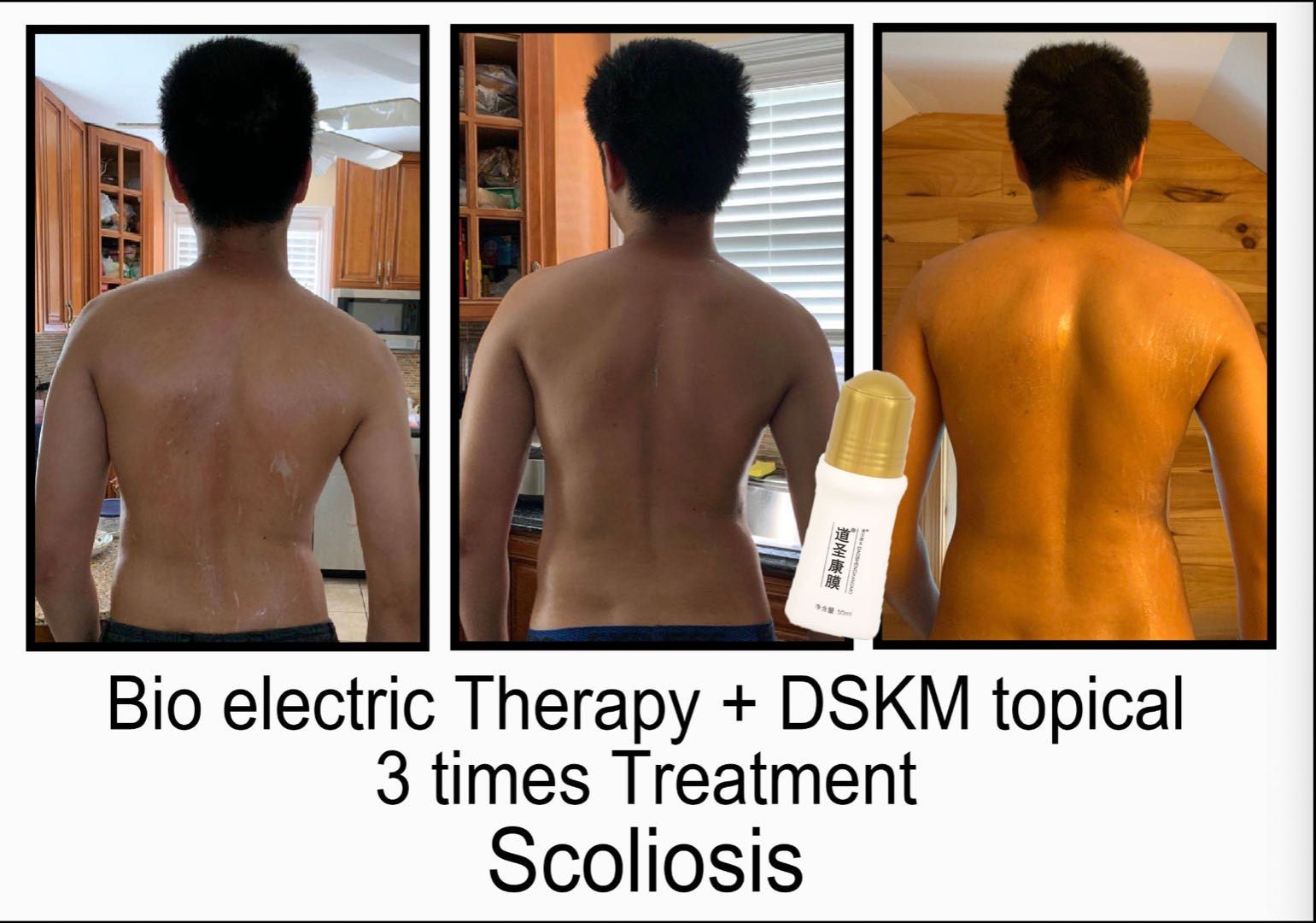 Three pictures of a man 's back with the words bio electric therapy + dskm topical 3 times treatment scoliosis