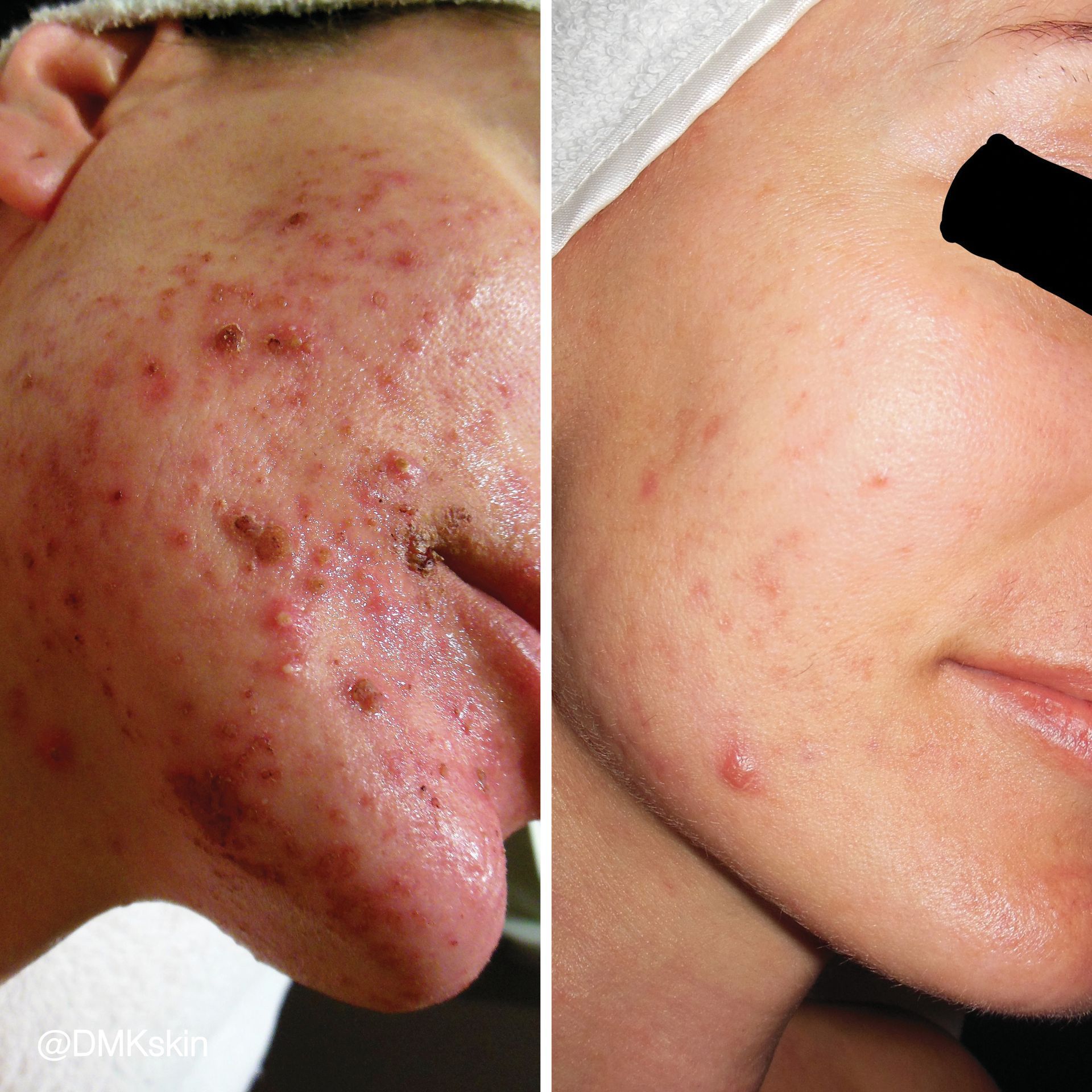 DMK skin treatment before and after for acne-prone skin