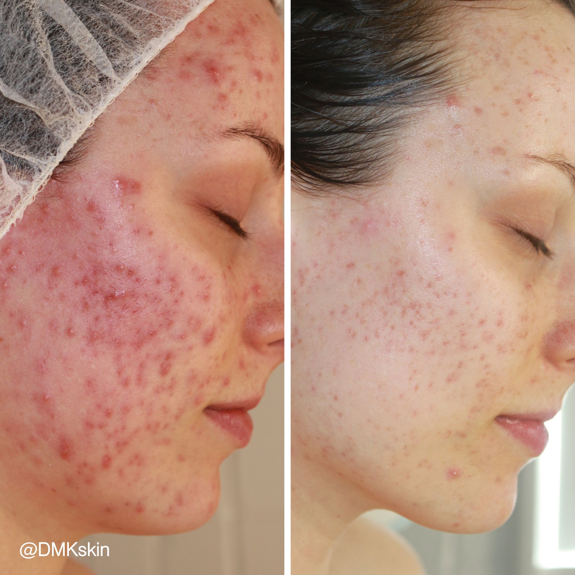 DMK acne treatment before and after