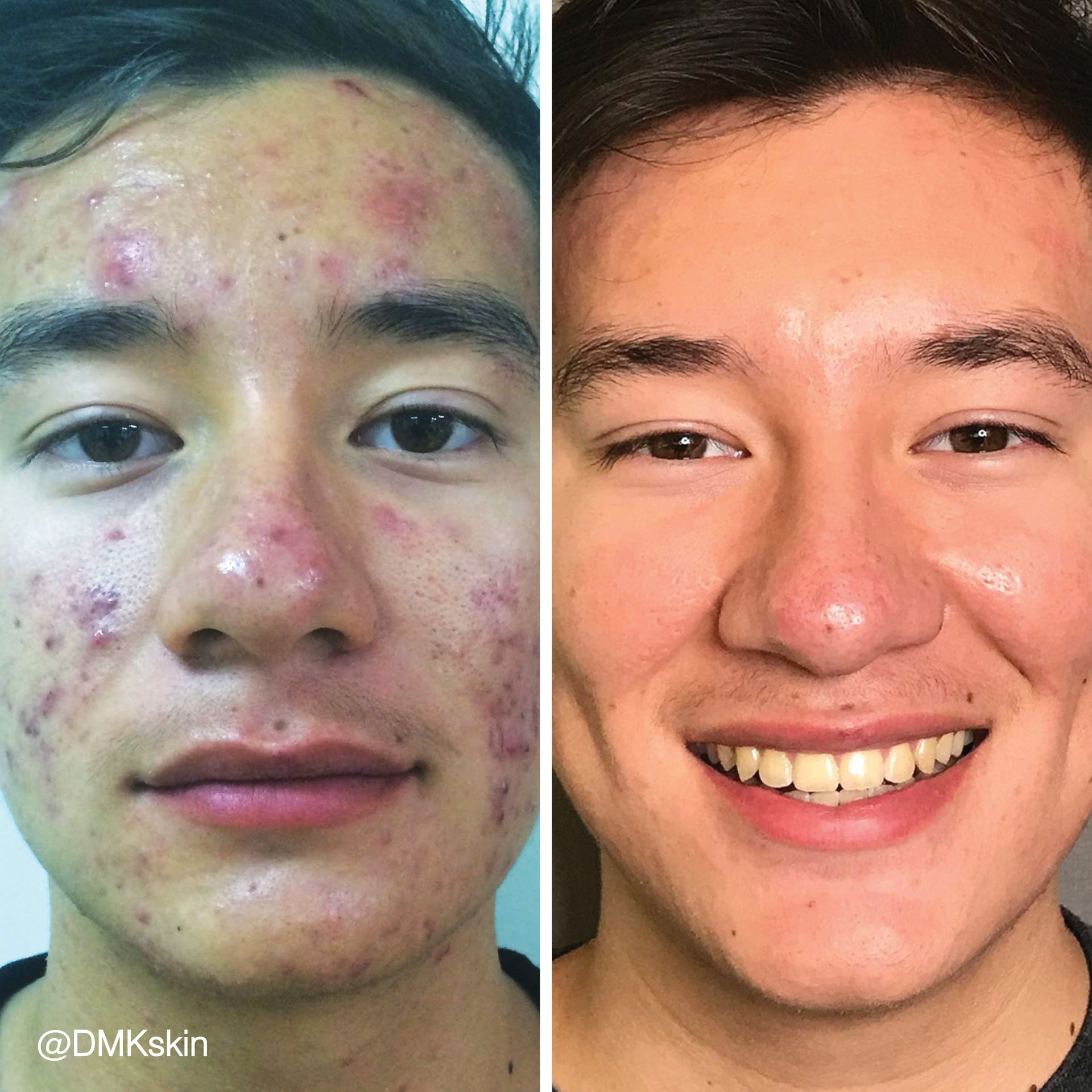 Acne skin treatment before and after