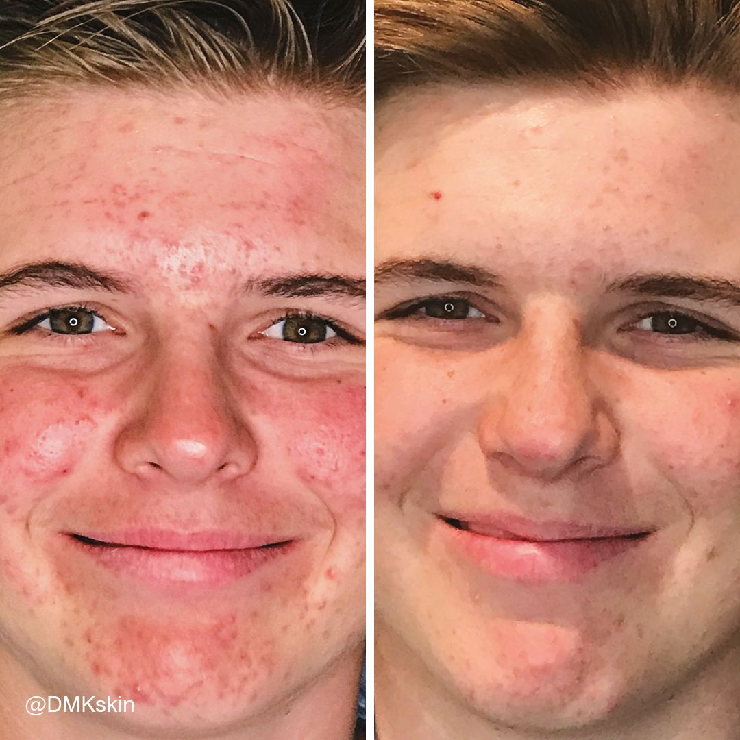 Acne and redness treatment before and after