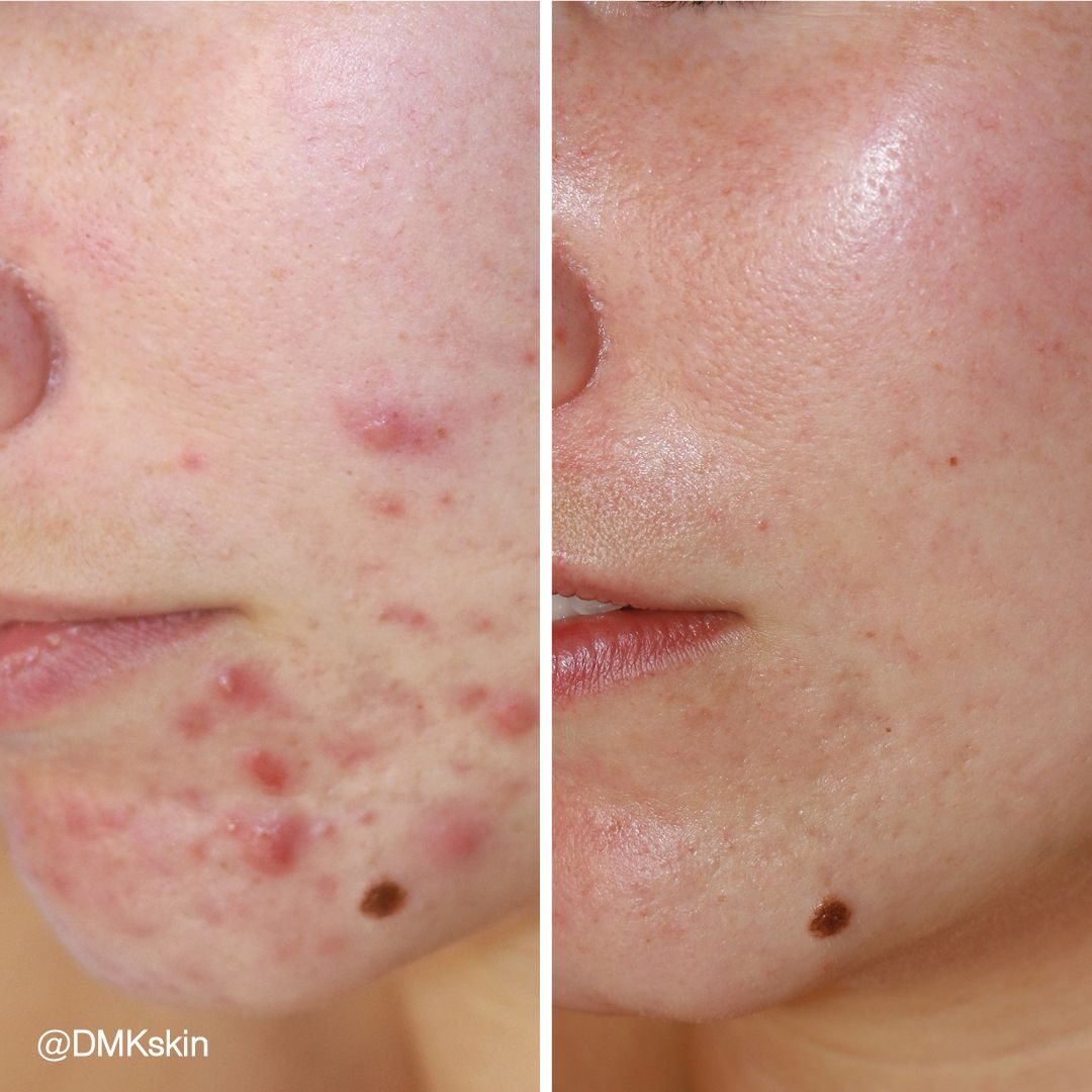 Skin clearing treatment before and after for acne-prone skin