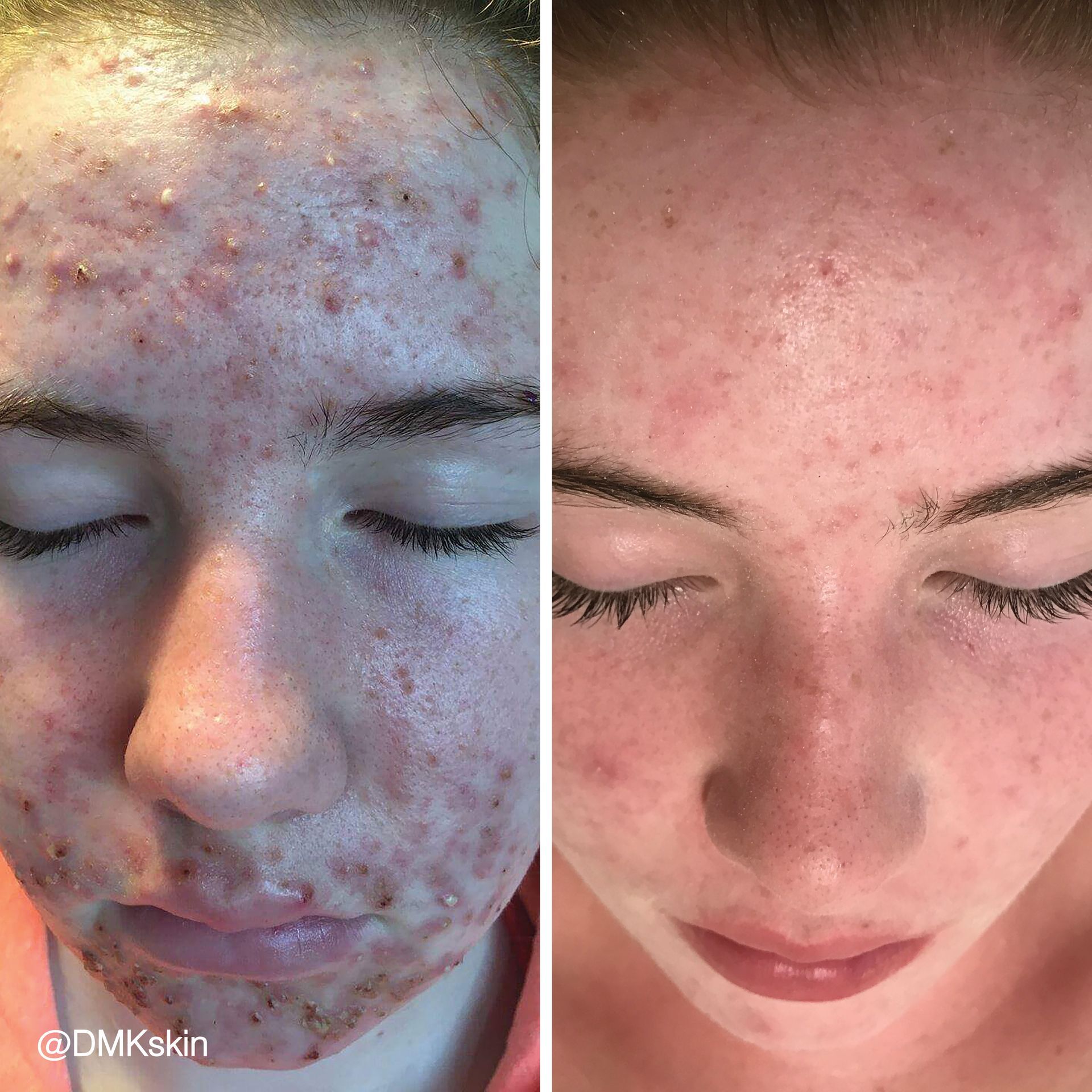 Acne scarring treatment before and after