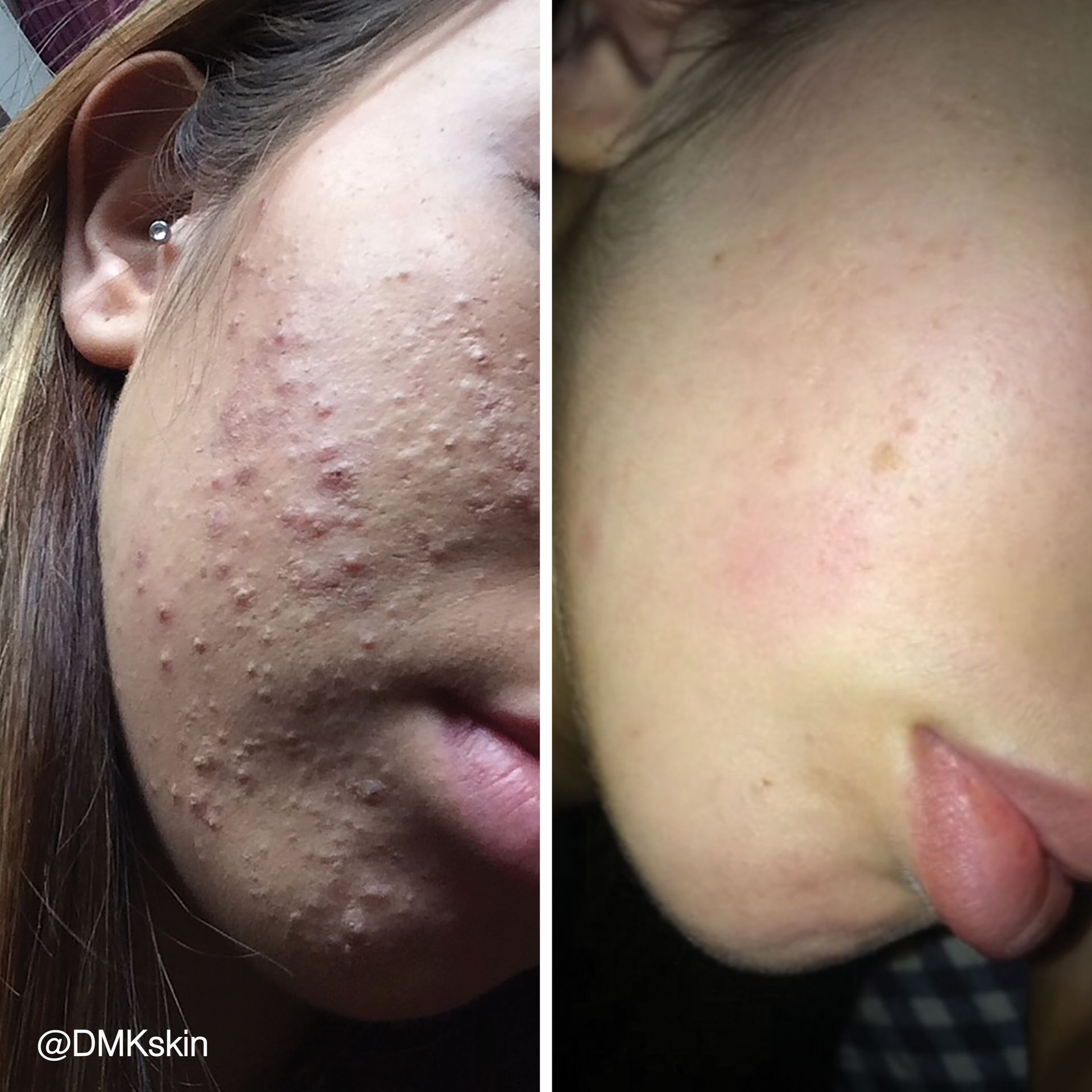 before and after for acne-prone skin