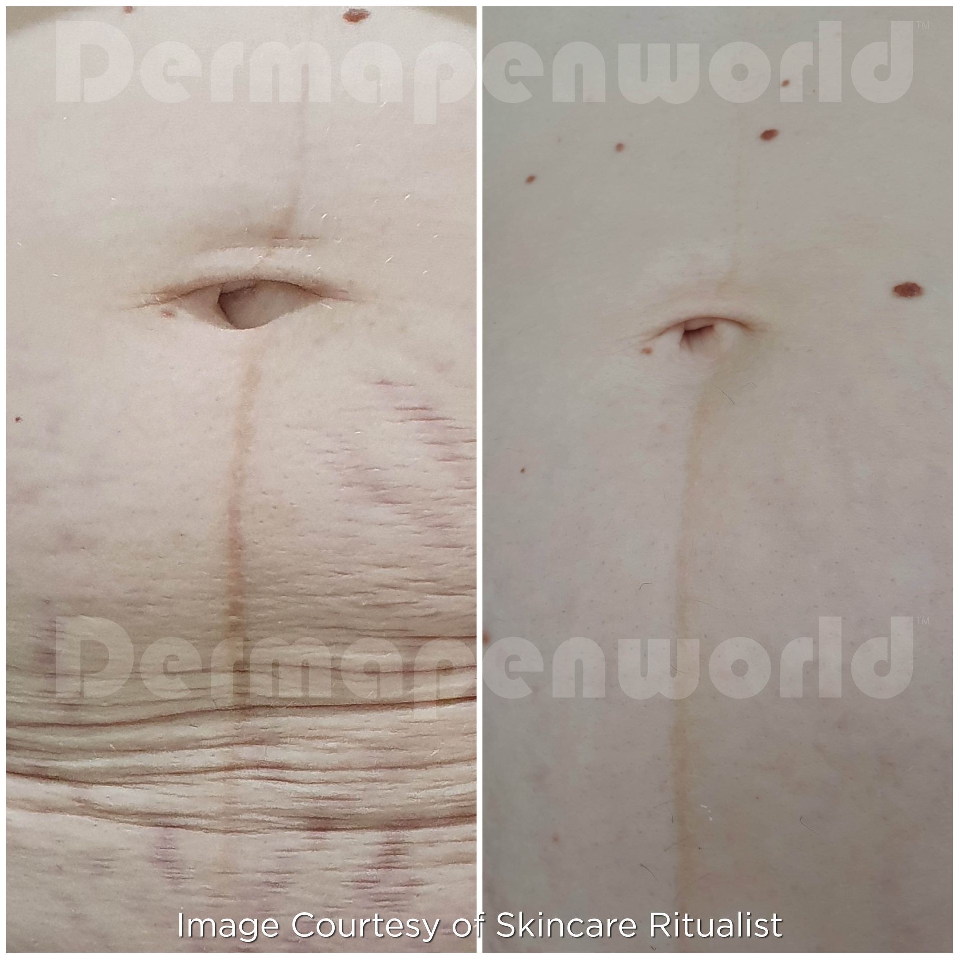 A before and after photo of a woman 's belly