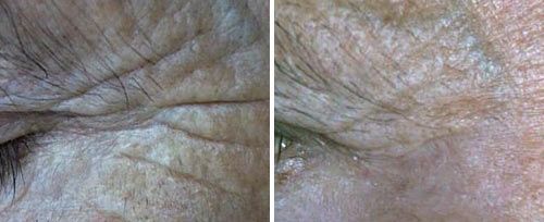 A before and after picture of a woman 's face with wrinkles.