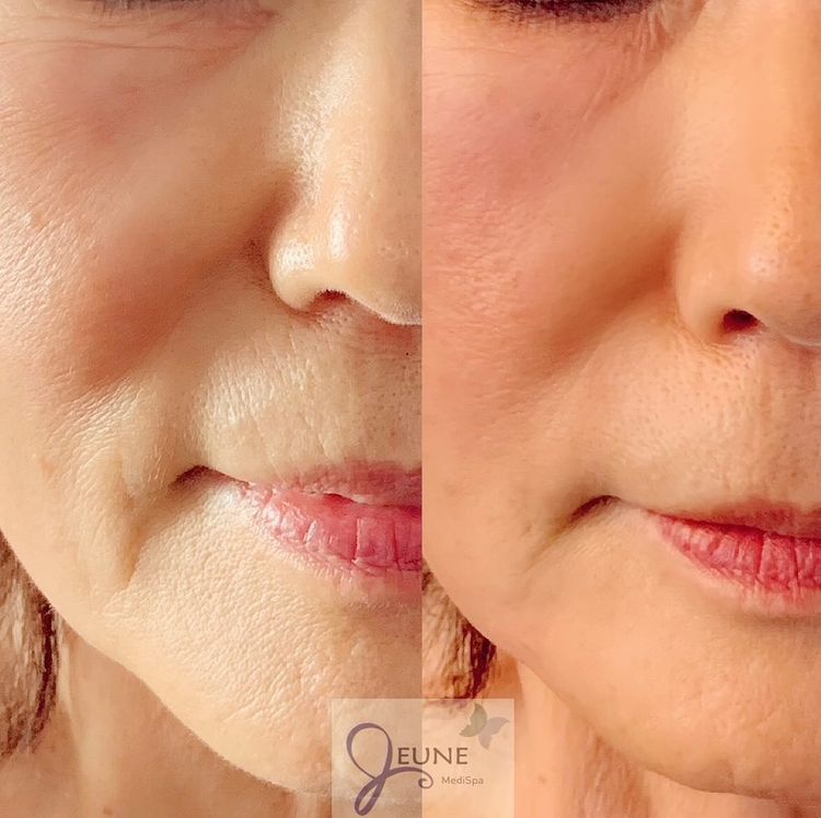 Softening Facial Lines — Tustin, CA — RoseK Medical Softening Facial Lines — Tustin, CA — RoseK Medical
