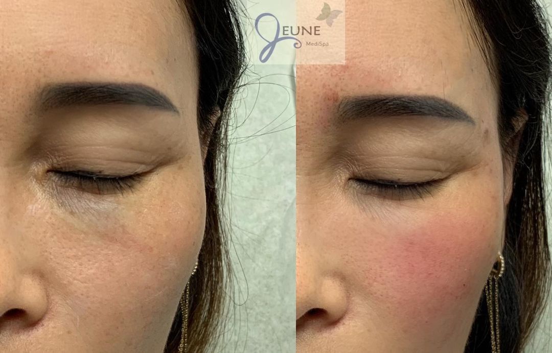 Lifted Cheeks and Rejuvenated Eyes — Tustin, CA — RoseK Medical