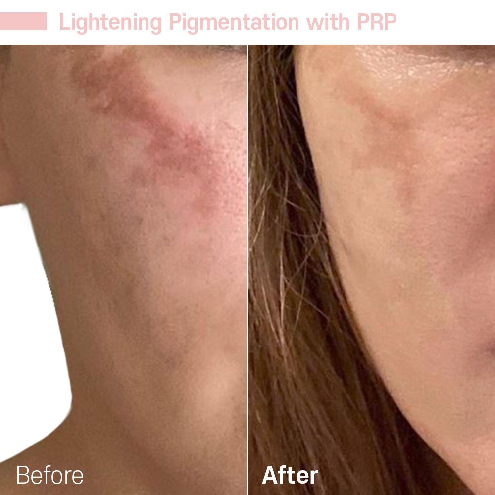 Smoother Forehead — Tustin, CA — RoseK Medical Smoother Forehead — Tustin, CA — RoseK Medical