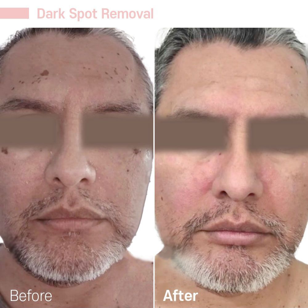 Before And After — Tustin, CA — RoseK Medical Before And After — Tustin, CA — RoseK Medical