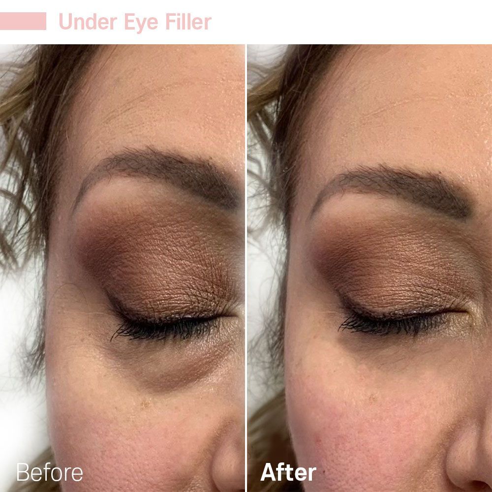 Under Eye Dermal Filler — Tustin, CA — RoseK Medical Under Eye Dermal Filler — Tustin, CA — RoseK Medical