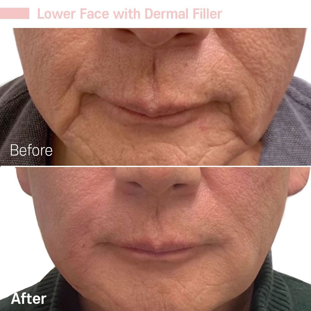 Under Eye Dermal Filler — Tustin, CA — RoseK Medical Under Eye Dermal Filler — Tustin, CA — RoseK Medical