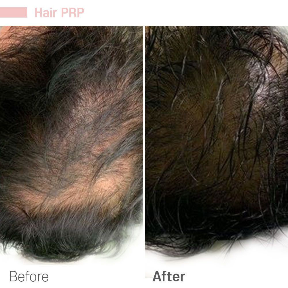Before And After Thirty Five — Tustin, CA — RoseK Medical