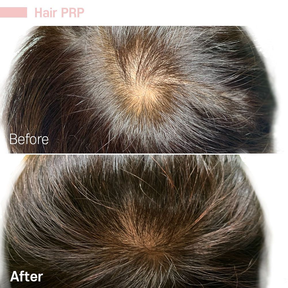 Before And After Thirty Three — Tustin, CA — RoseK Medical