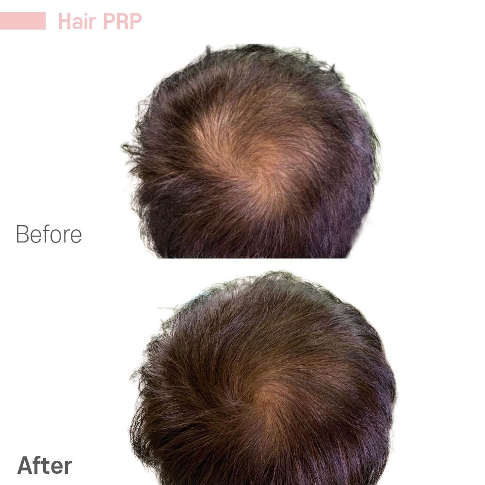 PRP Hair Treatment and Booster — Tustin, CA — RoseK Medical PRP Hair Treatment and Booster — Tustin, CA — RoseK Medical
