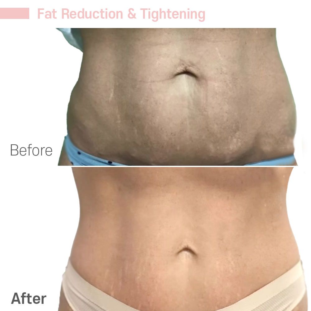 Before And After Thirty Two — Tustin, CA — RoseK Medical