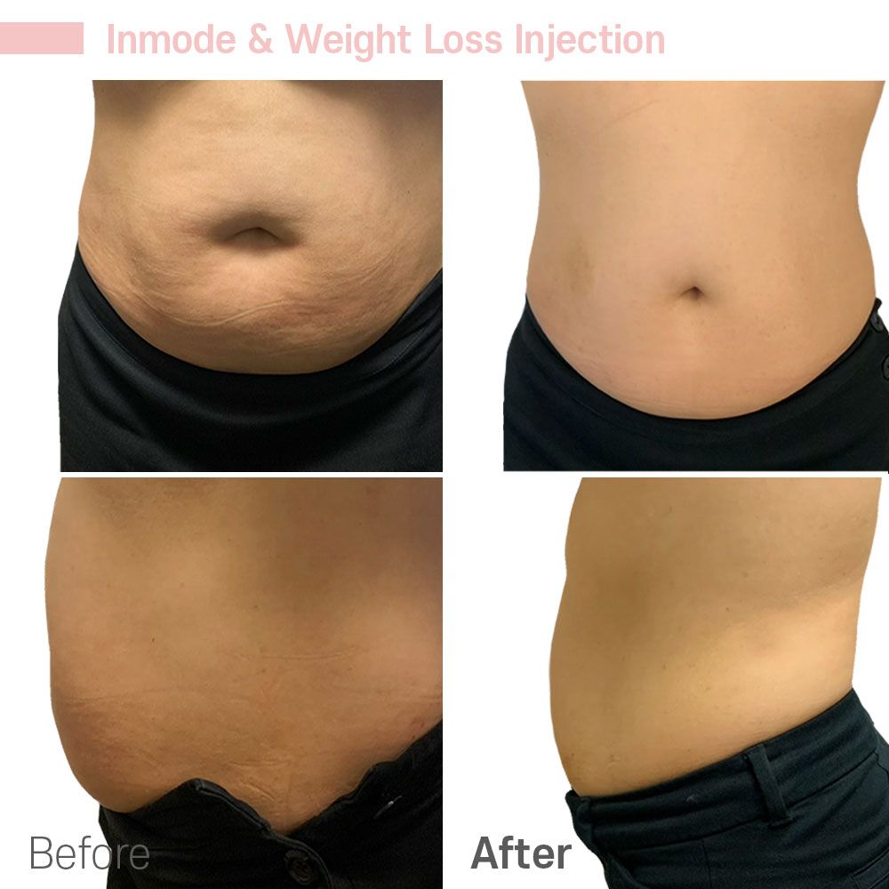 Before And After Thirty — Tustin, CA — RoseK Medical