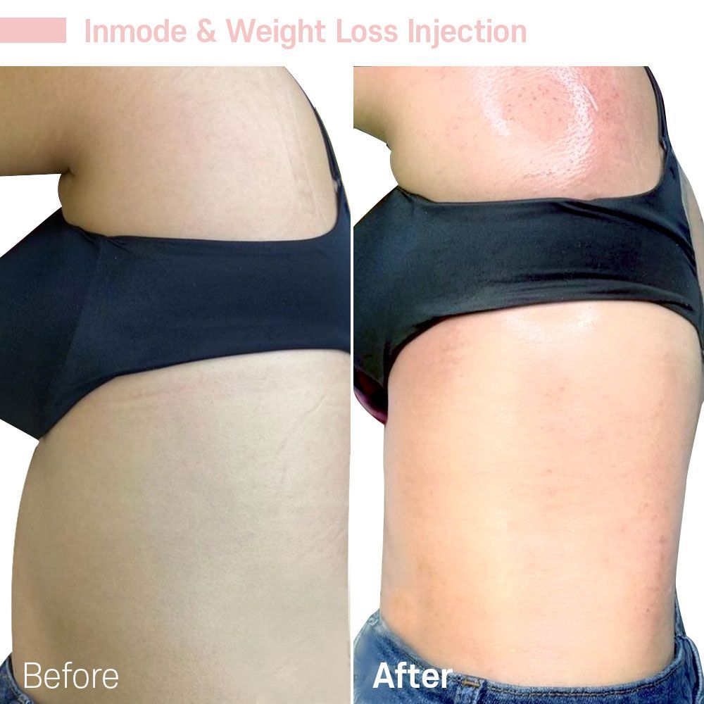 Before And After Twenty Nine — Tustin, CA — RoseK Medical