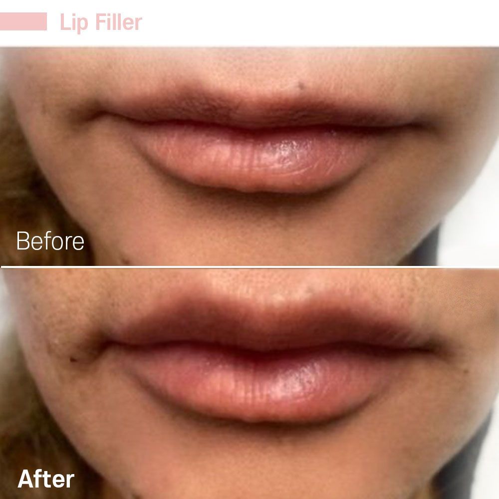 Before And After Twenty Seven — Tustin, CA — RoseK Medical
