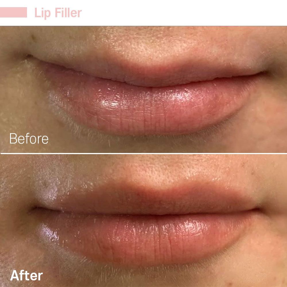 Before And After Twenty Two — Tustin, CA — RoseK Medical