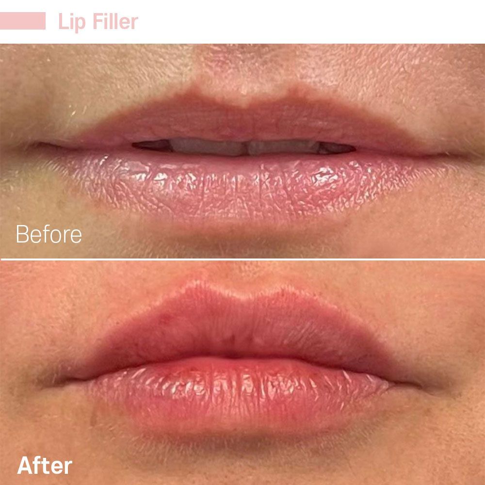 Before And After Twenty — Tustin, CA — RoseK Medical