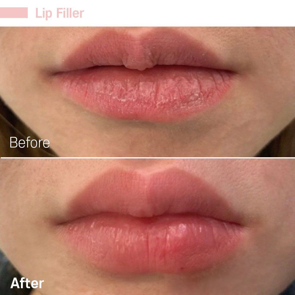 Before And After Twenty Seven — Tustin, CA — RoseK Medical
