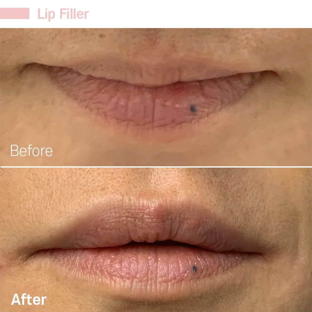 Men Lip Fillers — Tustin, CA — RoseK Medical