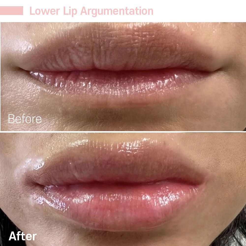 Before And After Twenty Five — Tustin, CA — RoseK Medical