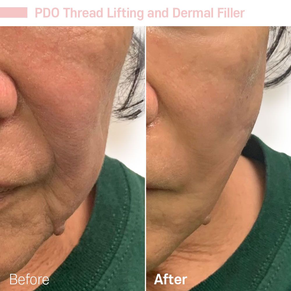 Thread Lift Procedure — Tustin, CA — RoseK Medical Thread Lift Procedure — Tustin, CA — RoseK Medical