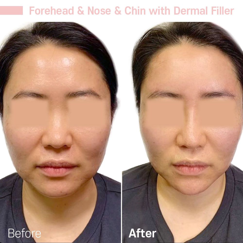 Before And After One — Tustin, CA — RoseK Medical