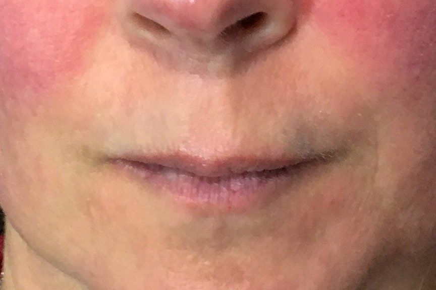 Juvederm Vollure Before Picture at ERA Wellness Spa in Georgetown KY