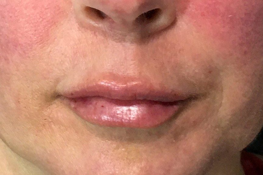 Juvederm Vollure After at ERA Wellness Spa in Georgetown KY