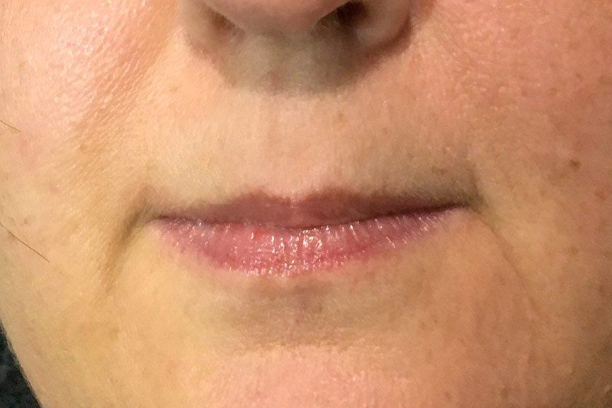 Juvederm Vollure plus Lip Flip Before at ERA Wellness Spa in Georgetown KY