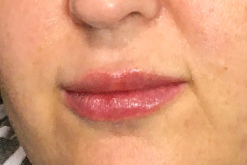 Juvederm Vollure plus Lip Flip After at ERA Wellness Spa in Georgetown KY