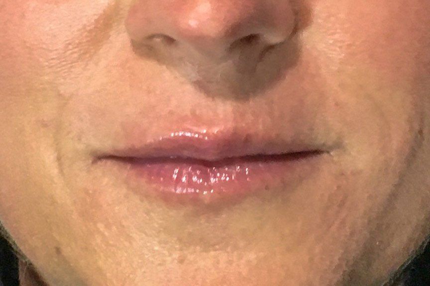 Juvederm Volbella Before at ERA Wellness Spa in Georgetown KY