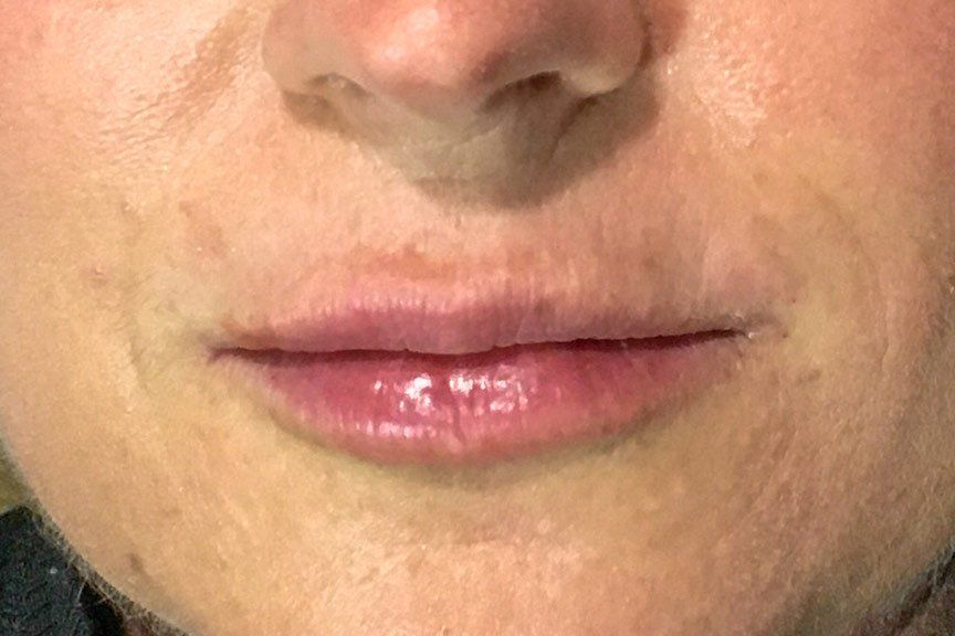 Juvederm Volbella After at ERA Wellness Spa in Georgetown KY