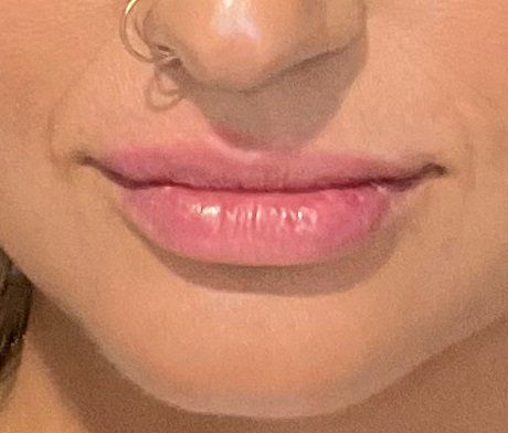 Juvederm Volbella After at ERA Wellness Spa in Georgetown KY