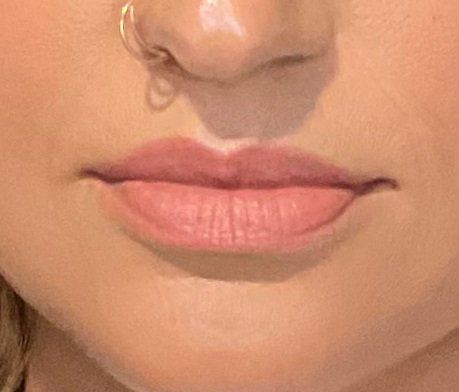 Juvederm Volbella Before at ERA Wellness Spa in Georgetown KY