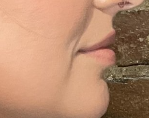 Juvederm Volbella Before at ERA Wellness Spa in Georgetown KY
