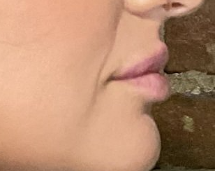 Juvederm Volbella After at ERA Wellness Spa in Georgetown KY