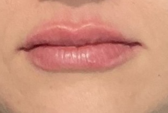 Juvederm Ultra After at ERA Wellness Spa in Georgetown KY