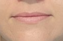 Juvederm Ultra Before at ERA Wellness Spa in Georgetown KY