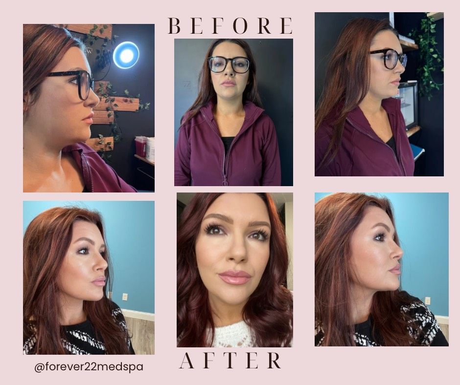 Before and after photos showing facial cosmetic changes.