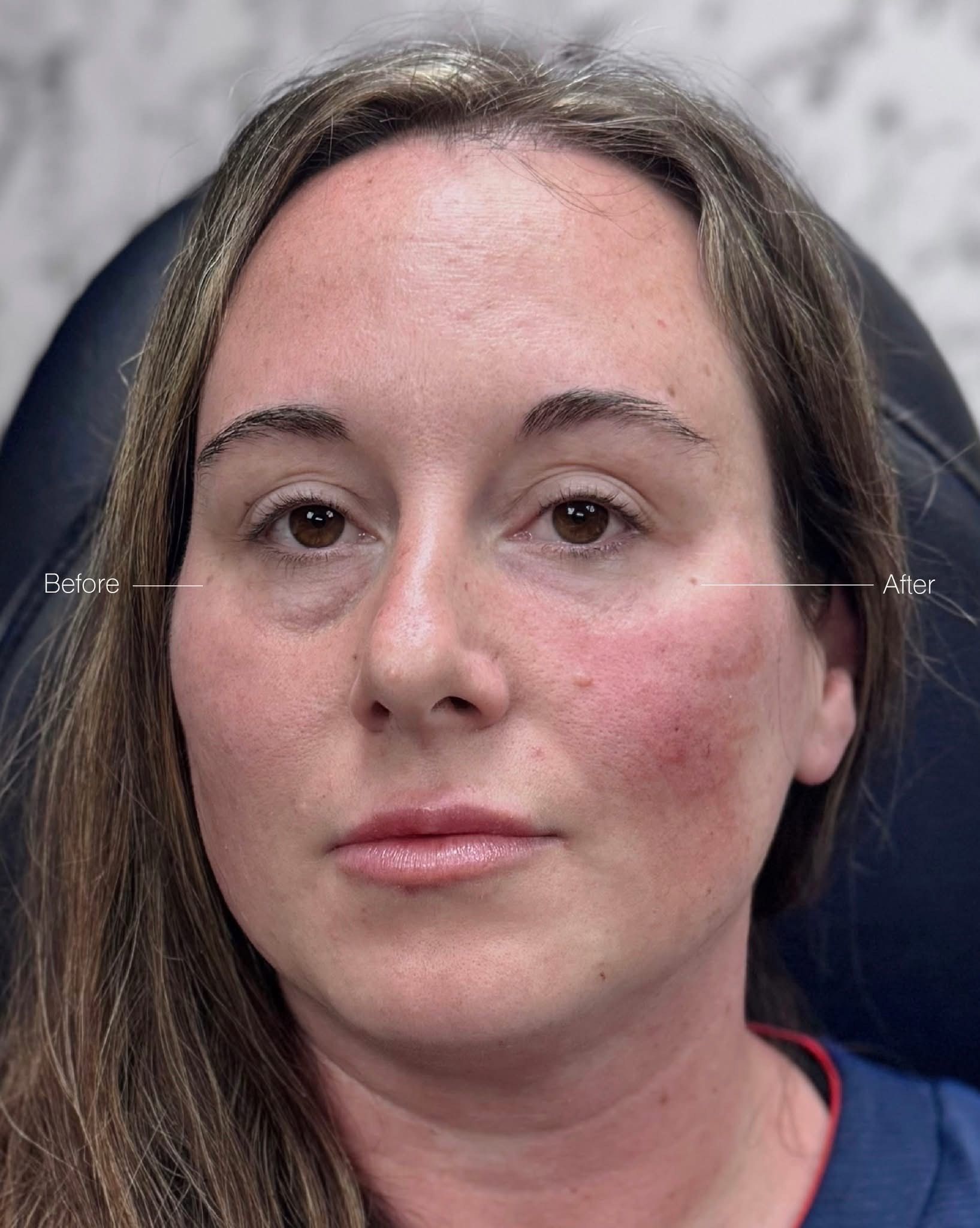 Woman with reddish cheeks and eyebrows outlined, seated indoors.
