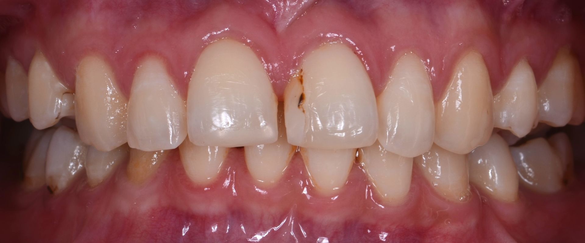 A close up of a person 's teeth with a few holes in them.