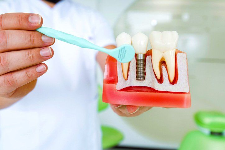 dentist holding dental implants model