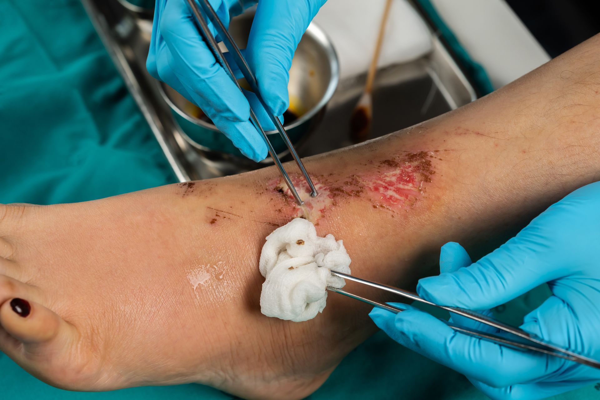  Cleaning wound on the leg