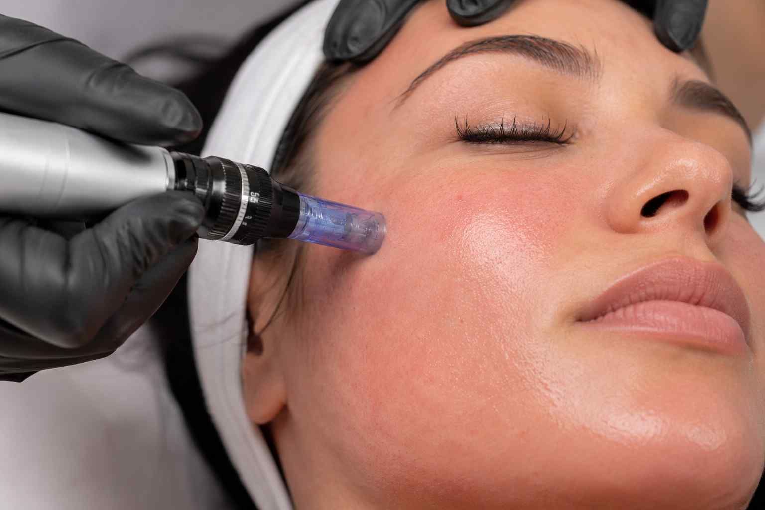 Gloved hand using a dermaroller on a woman’s cheek during a facial treatment