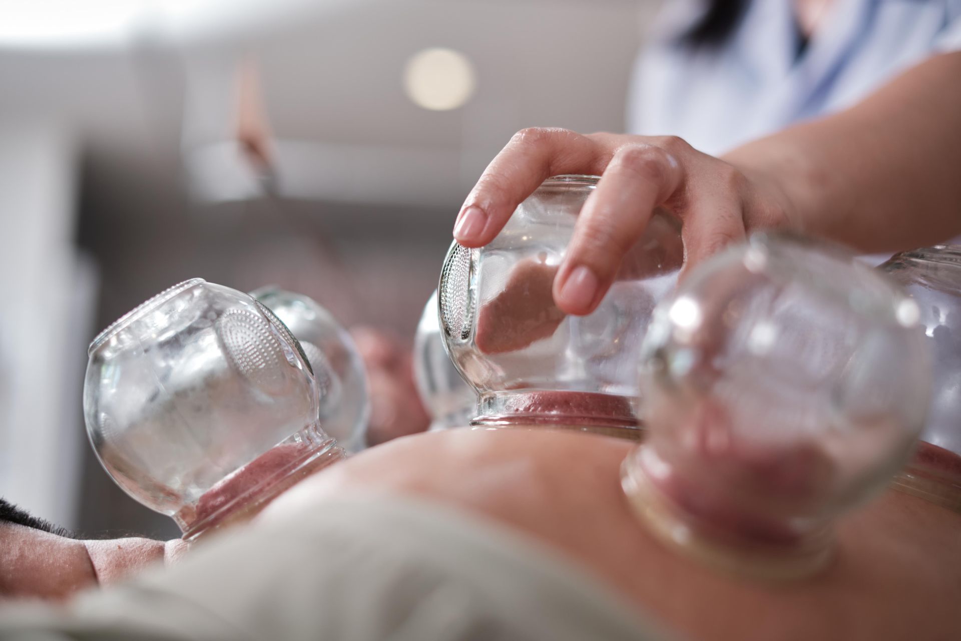 Therapist placing heated cups on a patient’s back during cupping therapy
